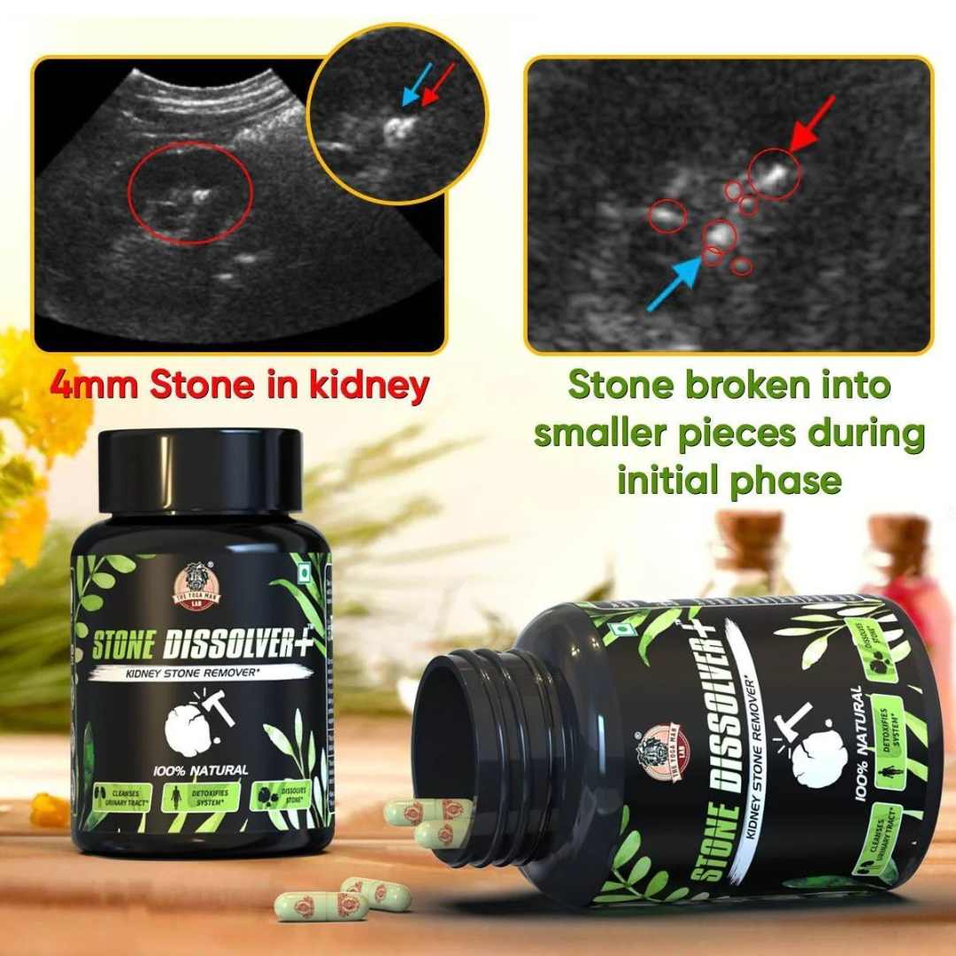 Stone Dissolver™ x 20 Cápsulas – Riñones Limpios y Sin Dolor 💧